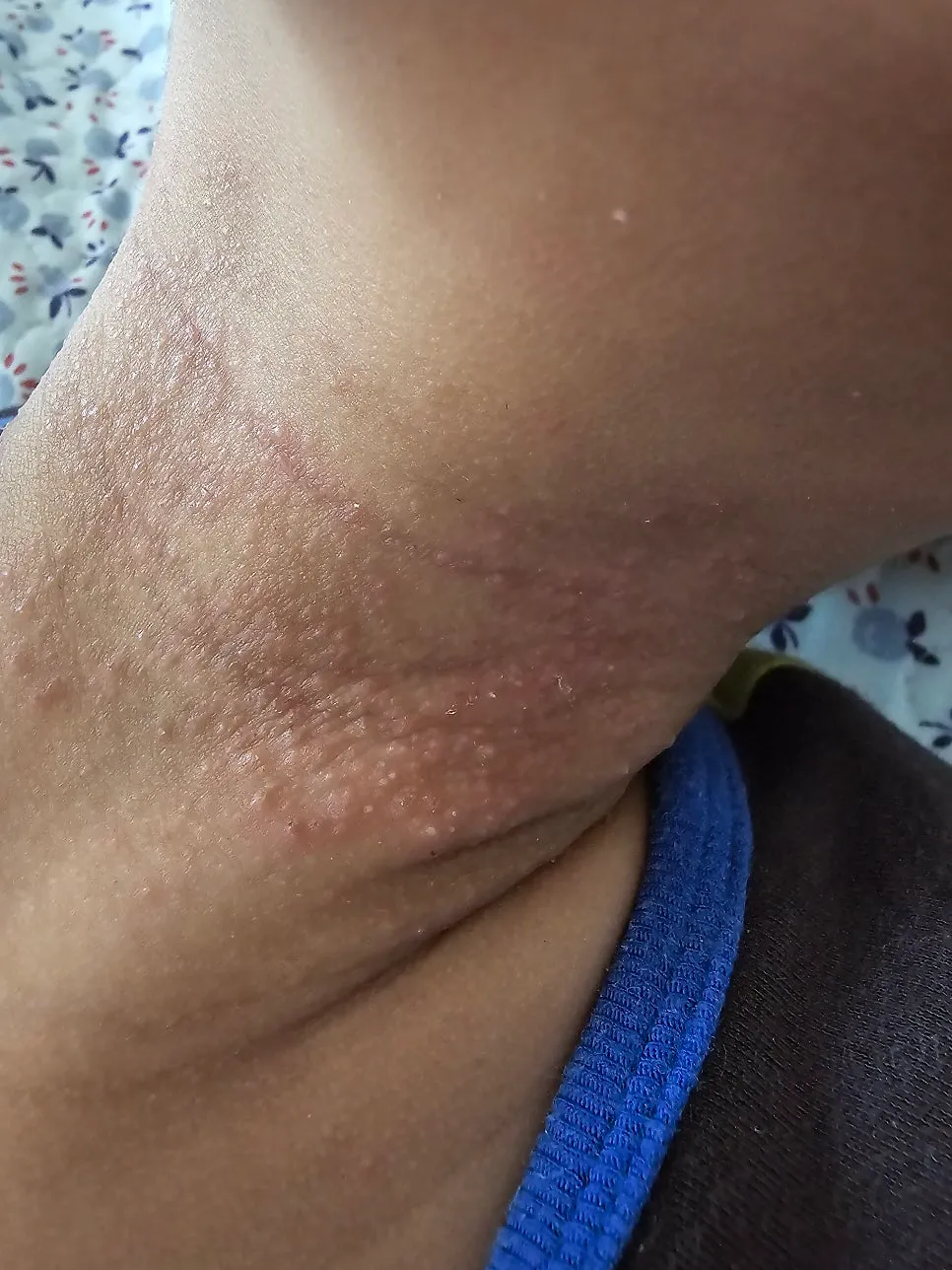 아토피 한의사의 아들,딸 치료기록.