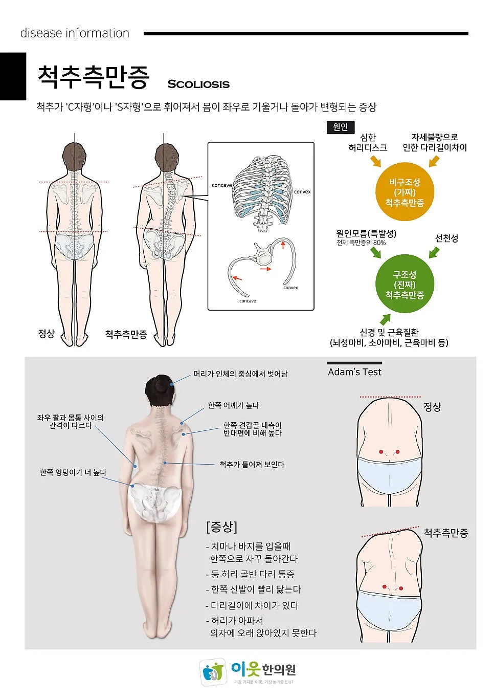 측만증의 진료와 cobb's angle 측정. 척추 측만증 관리 스트레칭.