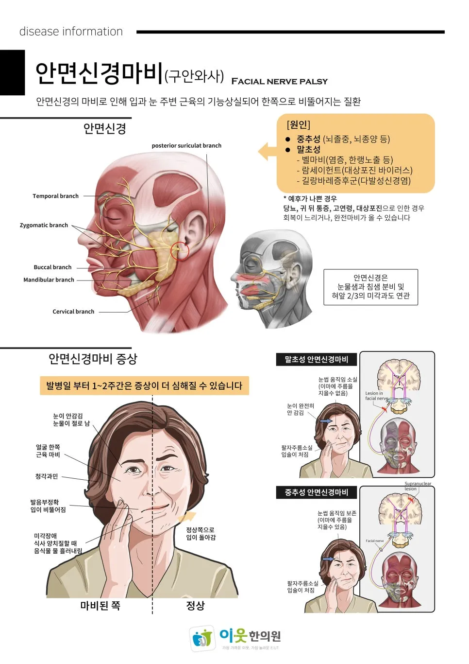 구안와사 와 안면떨림의 차이, 그리고 미세혈관감압술(MVD)