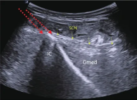 Superior cluneal nerve(상둔피신경) 통증