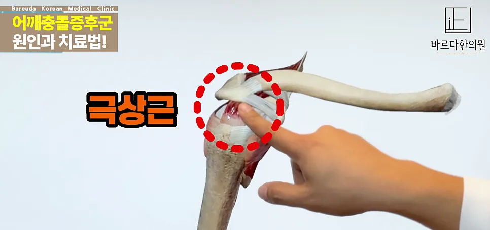 대전어깨충돌증후군 - 어깨가 결리고 팔을 못 올리겠어요!