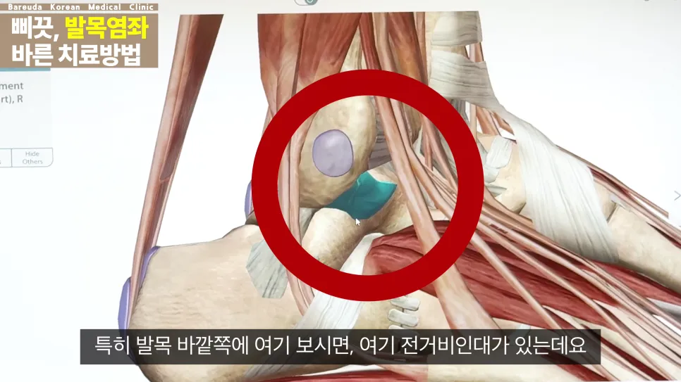 대전발목치료 - 발목을 자주 삐끗하고 낫지 않아요