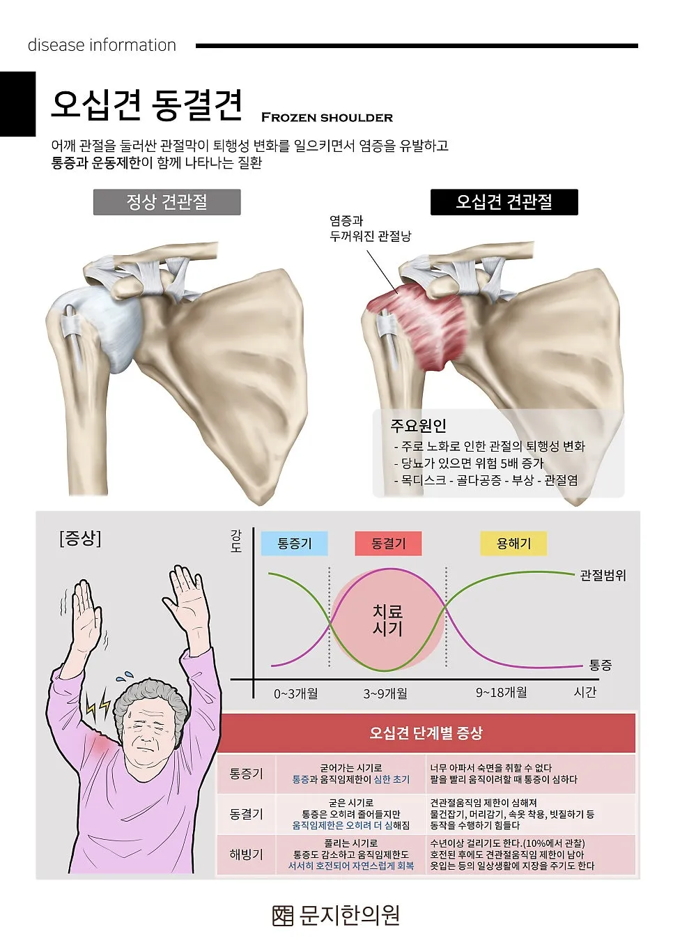 어깨가 점점 뻣뻣해지고 옷을 입고 벗기가 힘들어요. 특히 밤에 자려고 할 때 더 아파요.