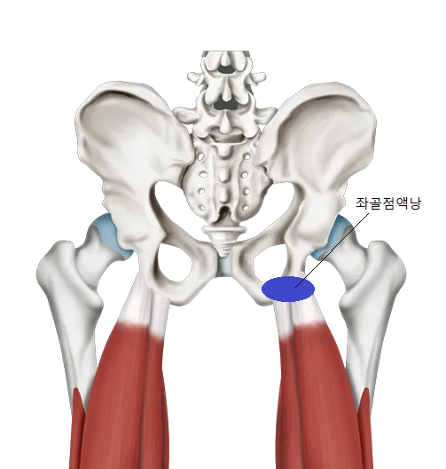 앉으면 엉덩이가 아파요. 좌골점액낭염(Ischial Bursitis)