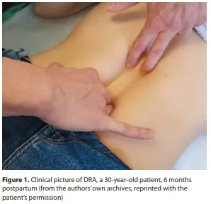 복직근 이개(Diastasis recti abdominis), 어떻게 치료해야할까요?