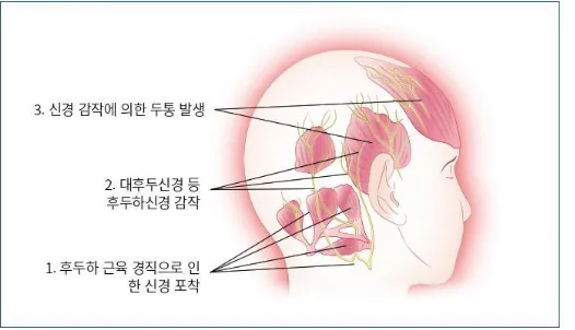 목때문에 발생한 두통은 어떤 차이점이 있을까요?(군산 명작한의원)