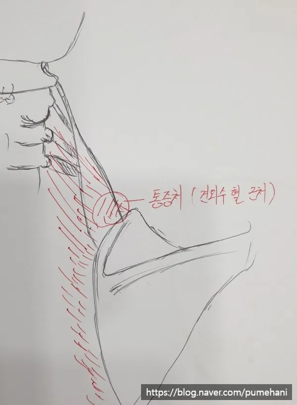 [전주한의원] 목 등 담걸렸을 때 증상과 원인 이렇게 바라봅니다.