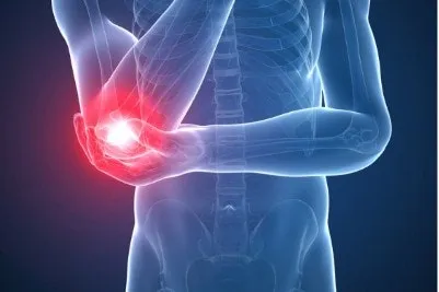팔꿈치가 아파요: 상완골 외측상과염(lateral epicondylitis)