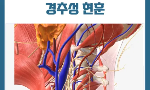 상부경추디스크로 인한 두통과 안면부 증상들 : 어지럼증, 후두통, 편두통, 이마의 통증, 눈썹의 통증, 안구의 불편감, 볼의 통증, 치아의 통증