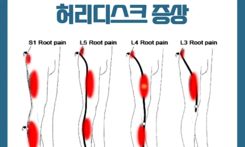 목디스크의 증상 2. 상부 경추디스크