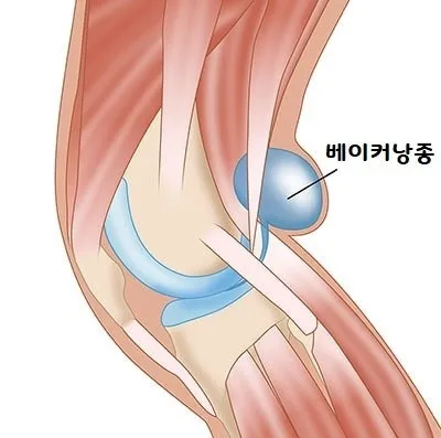 [여주 김한의원] 무릎 뒤가 땡기고 부었어요, "베이커낭종"