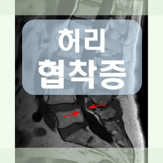 허리 협착증이란 (오래 걸으면 다리 아파요)