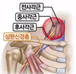 목디스크가 아닌데 팔이 저려요 : 사각근증후근과 약침치료 :마곡한의원