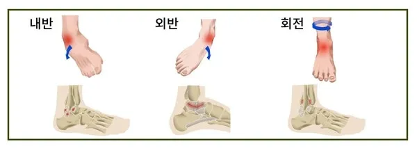 가열식화침 : 마곡동 만성통증 한의원에서 인대손상 치료