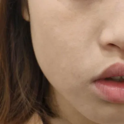 면역력 개선으로 호전된 피부컨디션 (아토피피부염, 편평사마귀) - After